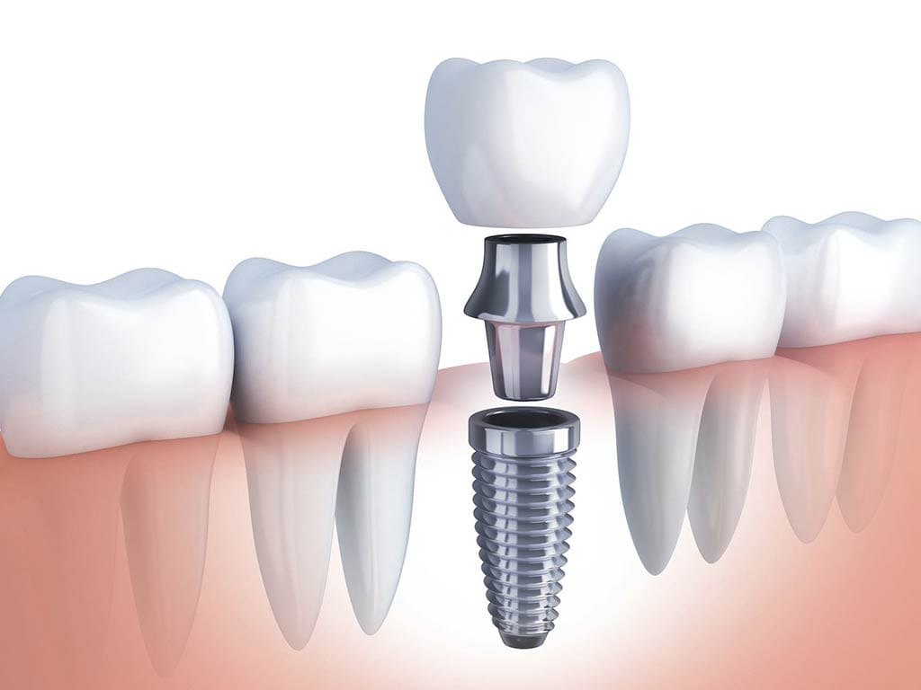 Implante Dental